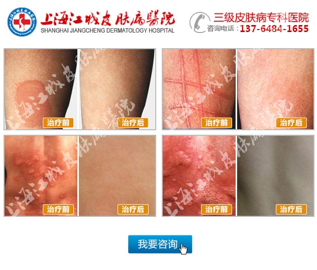 上海江城医院皮肤病专家团队针对传统疗法中